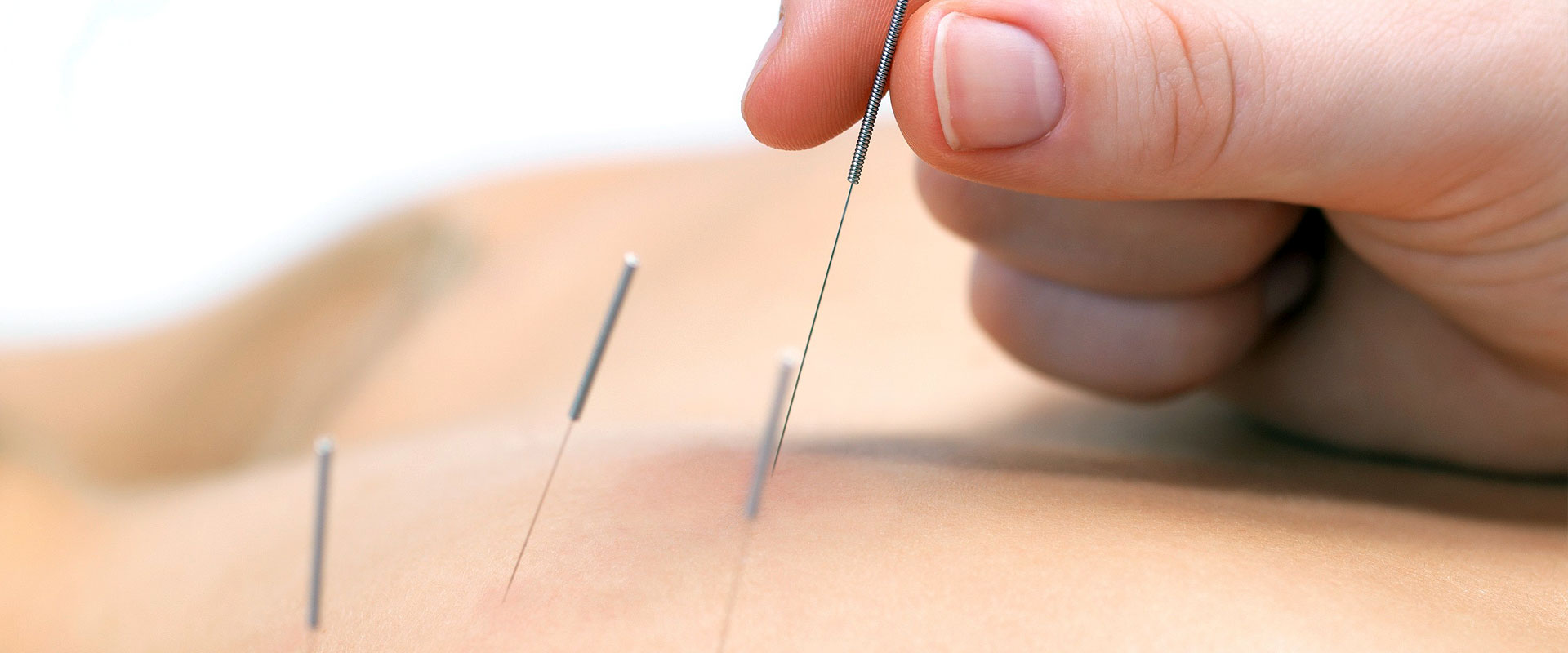 trigger point dry needling trigger point dry needling